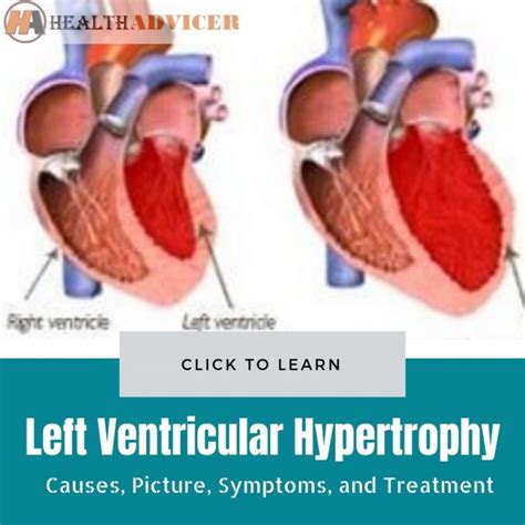 left ventricular hypertrophy treatment.